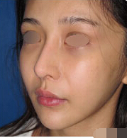 整形前后对比图片