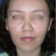 整形前后对比图片