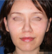 整形前后对比图片