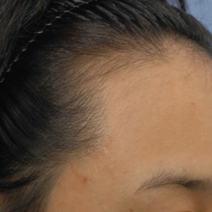 整形前后对比图片