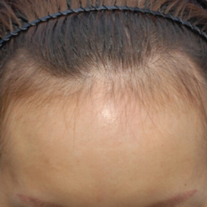 整形前后对比图片