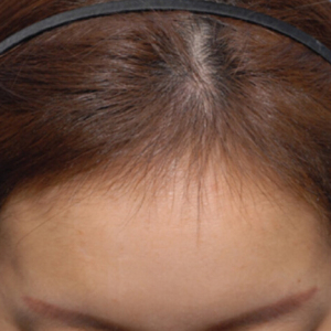 整形前后对比图片