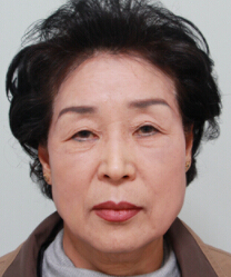 整形前后对比图片