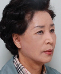 整形前后对比图片