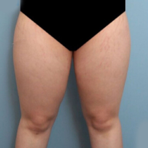 整形前后对比图片