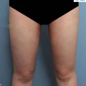 整形前后对比图片