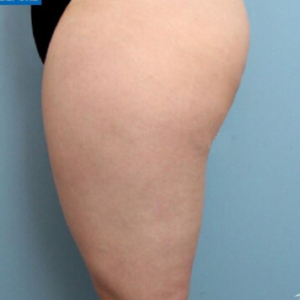 整形前后对比图片