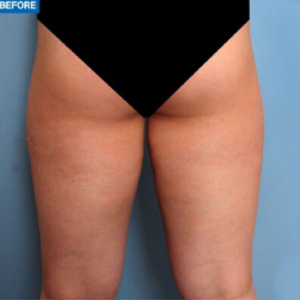 整形前后对比图片