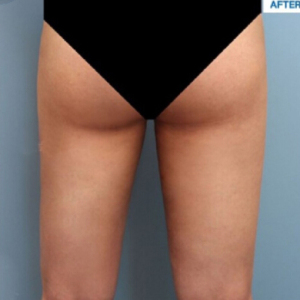 整形前后对比图片