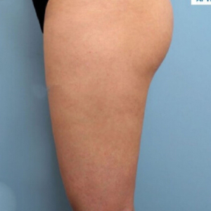 整形前后对比图片