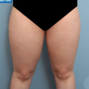 整形前后对比图片