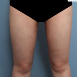 整形前后对比图片