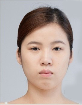 整形前后对比图片