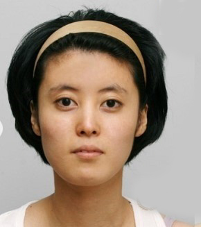 整形前后对比图片