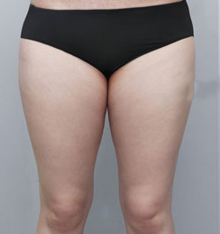 整形前后对比图片