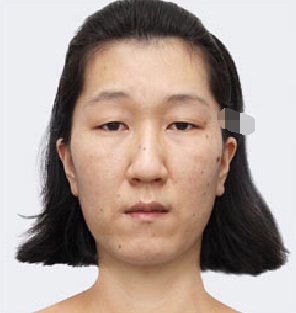 整形前后对比图片