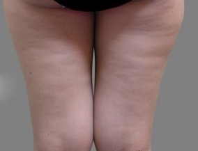 整形前后对比图片