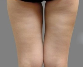 整形前后对比图片