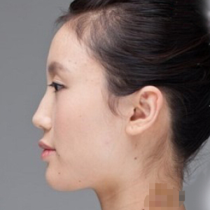 整形前后对比图片