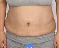 整形前后对比图片