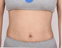 整形前后对比图片