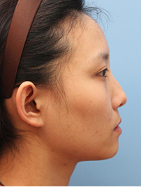 整形前后对比图片