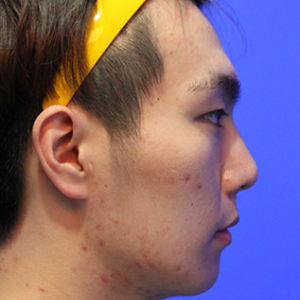 整形前后对比图片