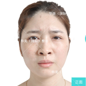 整形前后对比图片