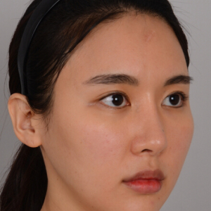 整形前后对比图片