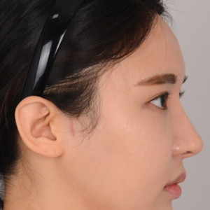 整形前后对比图片