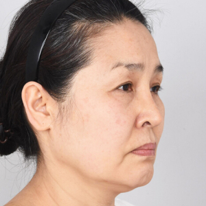 整形前后对比图片