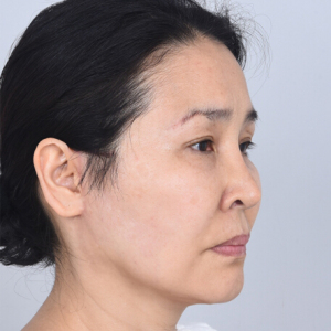 整形前后对比图片