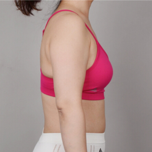 整形前后对比图片