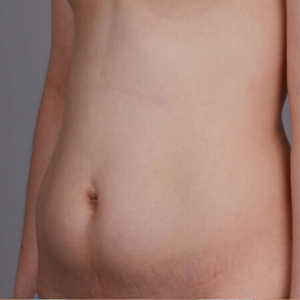 整形前后对比图片