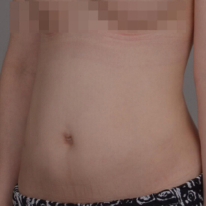 整形前后对比图片