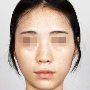 整形前后对比图片