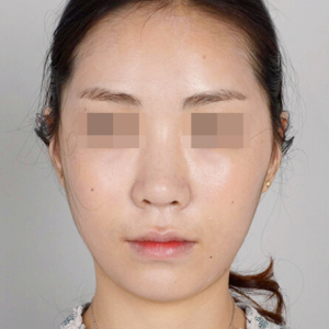 整形前后对比图片