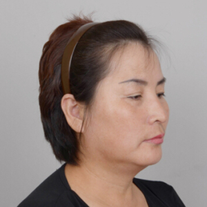 整形前后对比图片