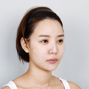 整形前后对比图片