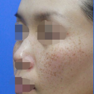 整形前后对比图片