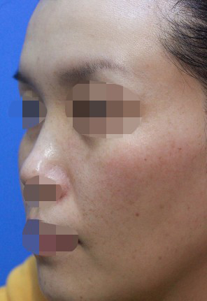 整形前后对比图片