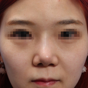 整形前后对比图片