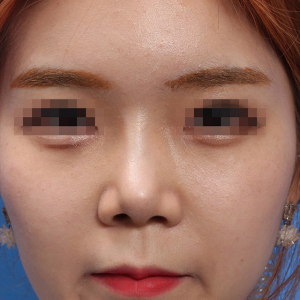 整形前后对比图片