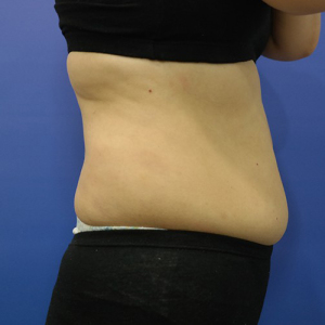 整形前后对比图片