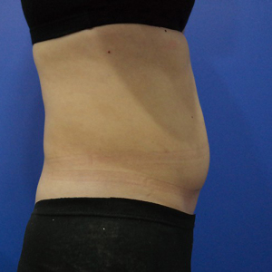 整形前后对比图片