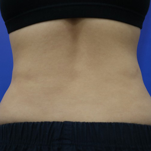 整形前后对比图片