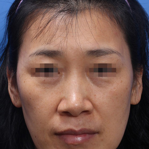 整形前后对比图片