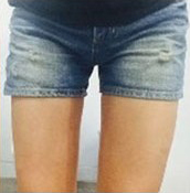 整形前后对比图片