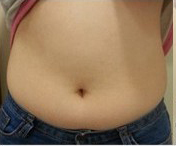 整形前后对比图片