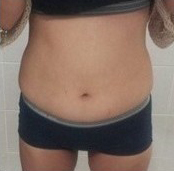 整形前后对比图片